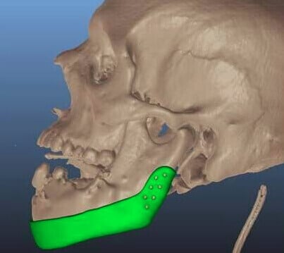 Sketch of the jaw implant (source: RHCC)