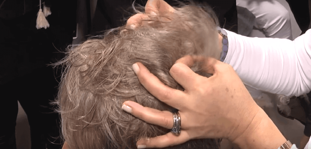 scalp