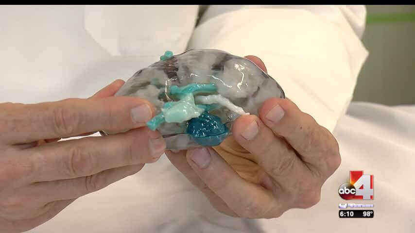 3D Printed model helps doctor remove tumor (Image: Good4Utah)