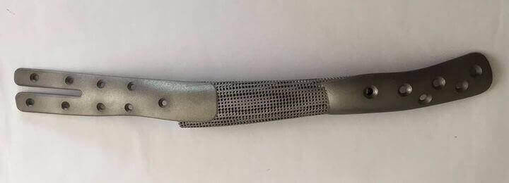 bone implant