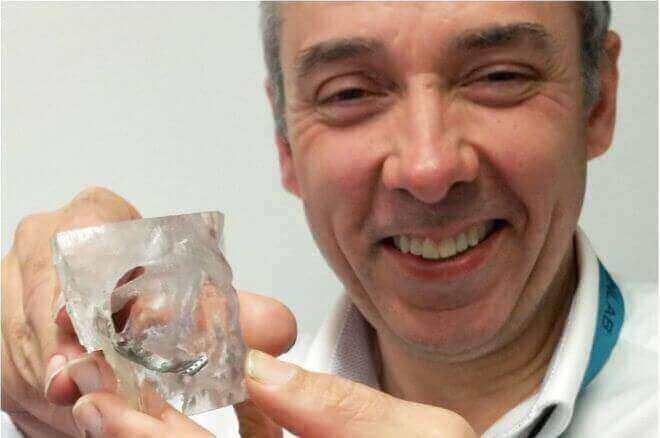 3D printed implants for facial reconstruction