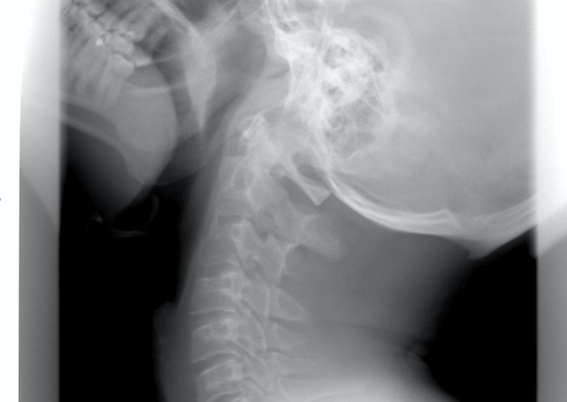 3D Printed Vertebrae