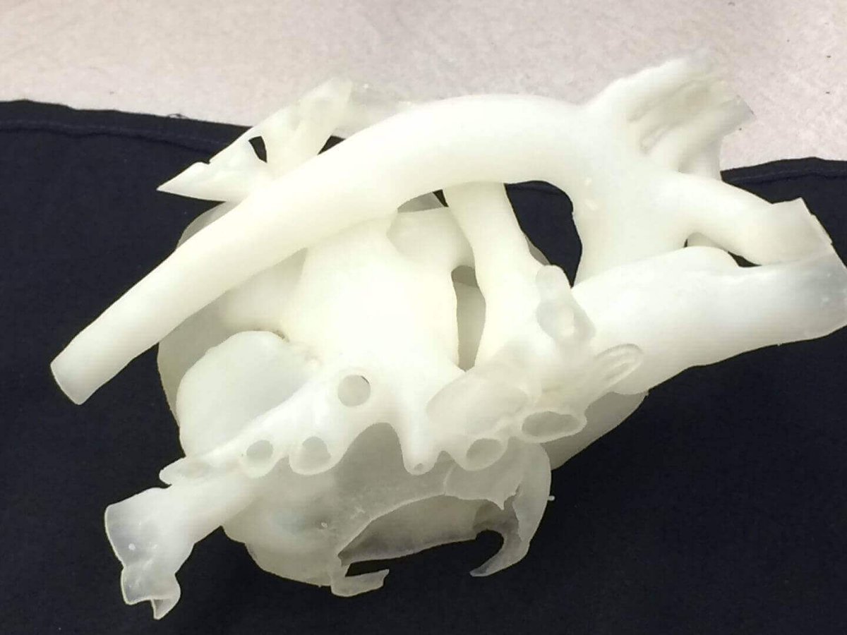 3d printing heart surgery