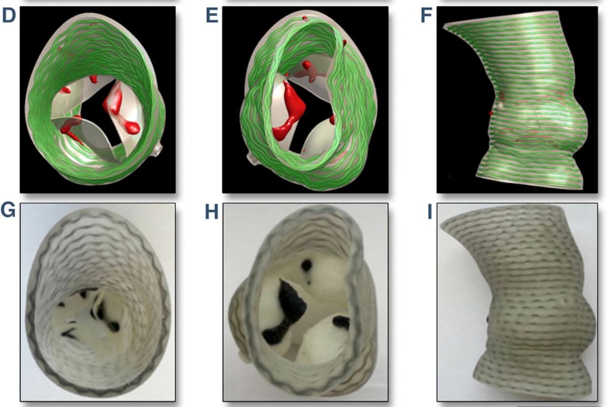 3D Printed Heart Valves Could Reduce PVL