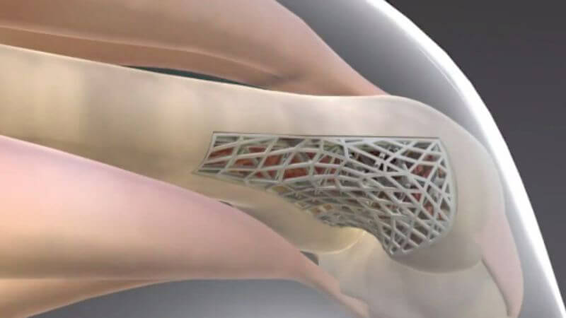 Bone cancer