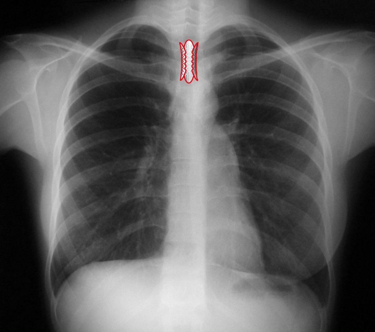 stent