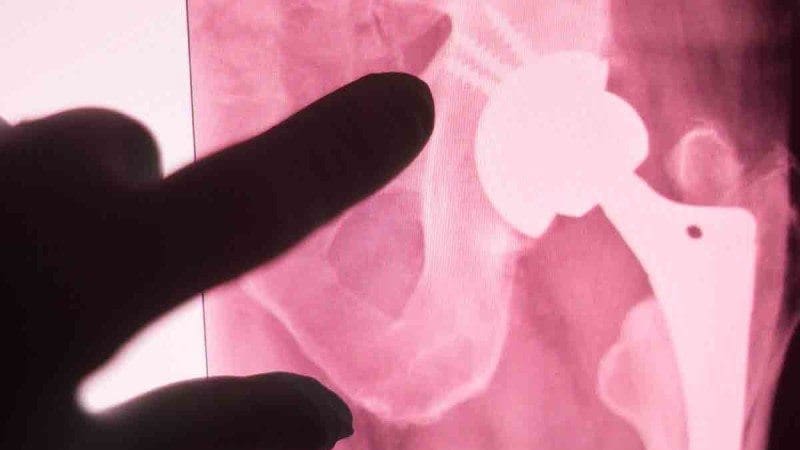 Featured image of 3D Printed Ceramic Implant Fuses With Bone to Repair Broken Limbs