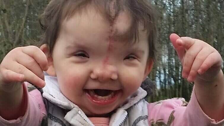 Featured image of How 3D printing reshaped one toddler’s face