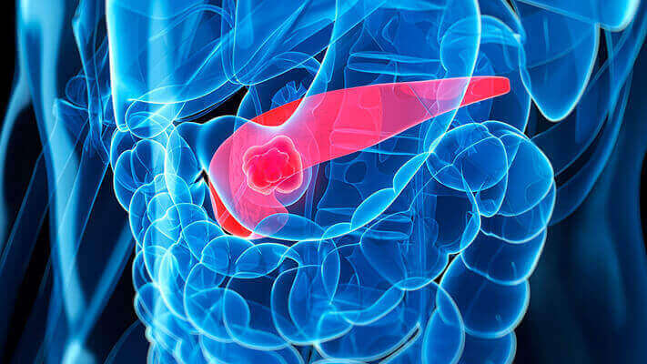 Featured image of Bioprinting an Artificial Pancreas for Type 1 Diabetes