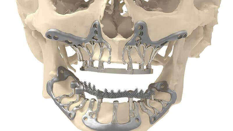 Featured image of CADSkills Develops 3D Printed Titanium Jaw Implant to Reduce Surgical Time