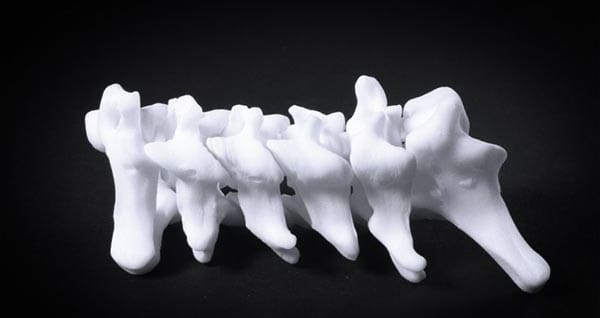 Featured image of 3D Modeling of Scoliosis Offers Non-invasive Diagnostic Options