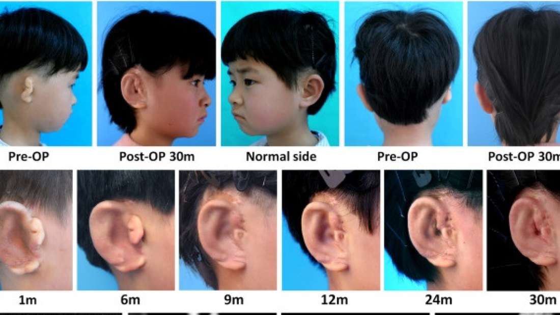 Featured image of Researchers 3D Bioprint the First Ears Made From Childen’s Own Cells