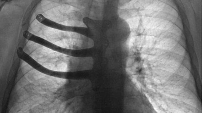 Featured image of Surgeons use 3D Printed Titanium Implant to Rebuilt Man’s Breastbone and Ribs