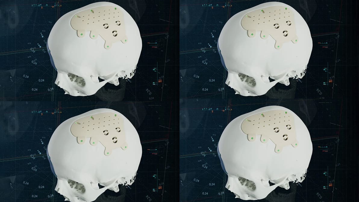 Image de l'en-tête de Materialise lance des implants CMF en PEEK, élargissant les options de matériaux pour la chirurgie personnalisée