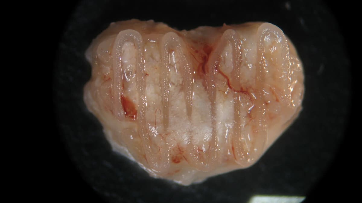 Featured image of Medical Breakthrough with 3D Printed Bone Implants