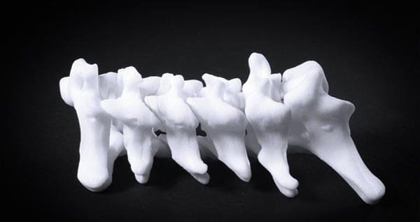 Featured image of 3D Modeling of Scoliosis Offers Non-invasive Diagnostic Options