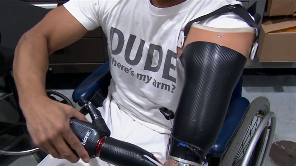 Featured image of Honda Employees 3D Print Prosthetic Arm for Colleague
