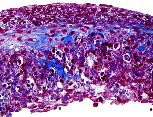 Structure of a 3D bioprinted blood vessel after 28 days of growth in bioreactor, with the polymer matrix shown in blue and cells in red.