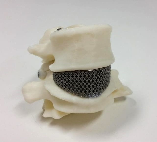 The first 3D printed spinal implant.