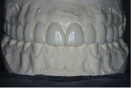 A dental restoration.