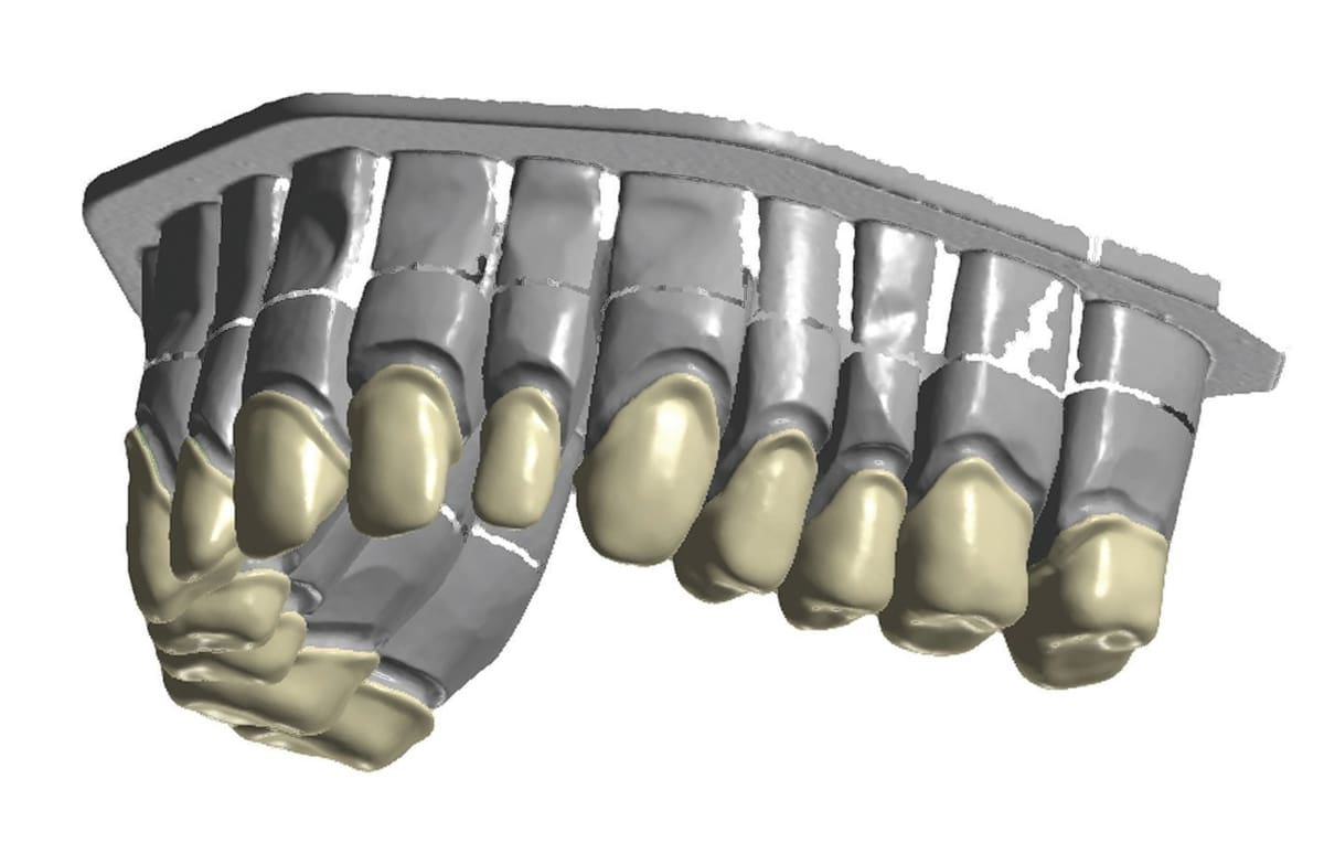 A CAD-construction of 14 single-crown copings.