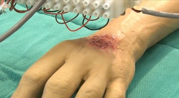 A skin bioprinter prints directly onto a model burn victim