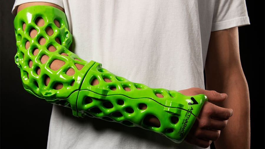 3D printed immobilizations are more ergonomic and hygienic than traditional casts and splints